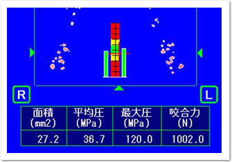 オ ク ル ー ザ ー（咬合力測定器）